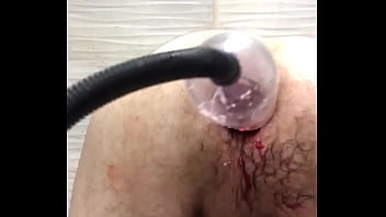 Prolapse anal