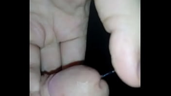 My dick after surgery My dick after surgery