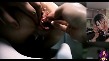 webcam anal prolapse