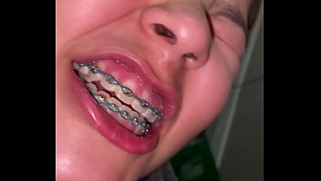 Braces cumshot dirty teeth