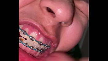 Braces cumshot dirty teeth