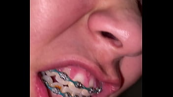Braces cumshot dirty teeth