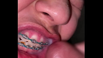 Braces cumshot dirty teeth