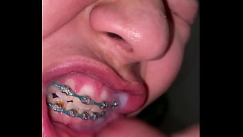 Braces cumshot dirty teeth