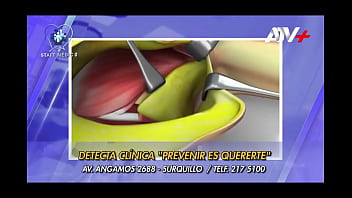 Compilation breast reduction