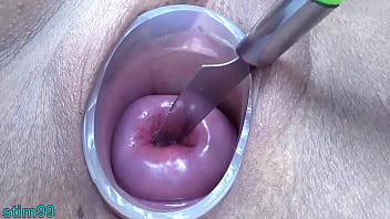 Hot Lesbians Get Prolapse Cervix With Catheters Inserted Into Their Uterus thumbnail