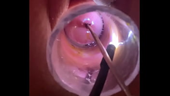 Electrosound cervix and m