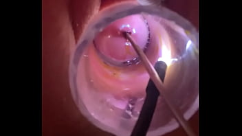 Electrosound cervix and m