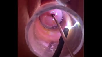 Electrosound cervix and m Electrosound cervix and m