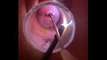 Electrosound cervix and m