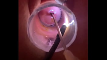 Electrosound cervix and m