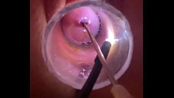 Electrosound cervix and m