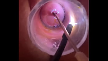 Electrosound cervix and m