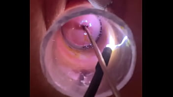 Electrosound cervix and m