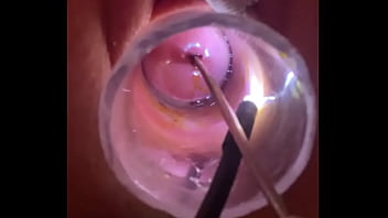 Electrosound cervix and m Electrosound cervix and m