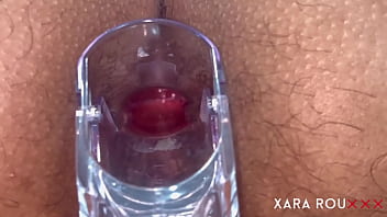 Anal vision speculum