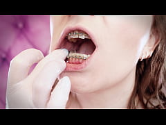 Play MP4 - ASMR&colon; upgraded braces with chain-link rubber bands and nitrile gloves