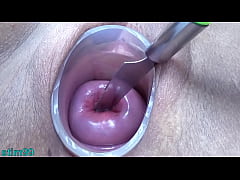 Play MP4 - Prolapsed Cervix Lesbians at the same time