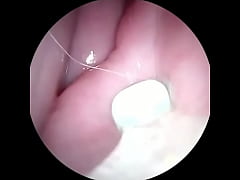 Play MP4 - Camera in fertile cervix