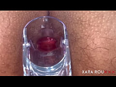 Play MP4 - Anal Vision Speculum